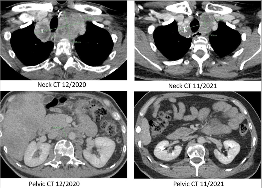  Computed tomography. CT scans of the neck and pelvis with contrast in December of 2020 (prior to Pralsetinib) and in November of 2021 (eleven months after the start of Pralsetinib). The 2020 neck CT showed a large mass at the thoracic inlet measuring 89mm x 50mm. In 2021 this same mass post treatment had decreased in size to 77mm x 41mm. The 2020 pelvic CT showed a retroperitoneal lymph node enlargement to 15mm, which resolved on the 2021 scan.